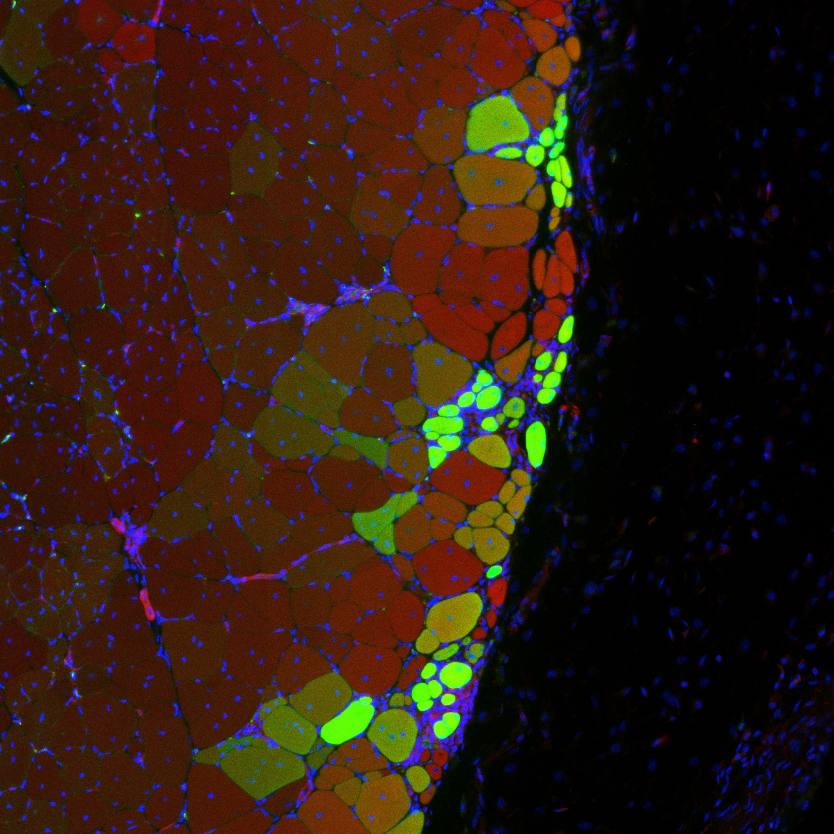 Hydrogel delivered stem cells called muscle satellite cells integrate to form new muscle strands, in green, along with existing muscle tissue, in red. Yellow strands may descend from existing muscle cells and from delivered MuSCs.
Hydrogel delivered stem cells called muscle satellite cells integrate to form new muscle strands, in green, along with existing muscle tissue, in red. Yellow strands may descend from existing muscle cells and from delivered MuSCs.