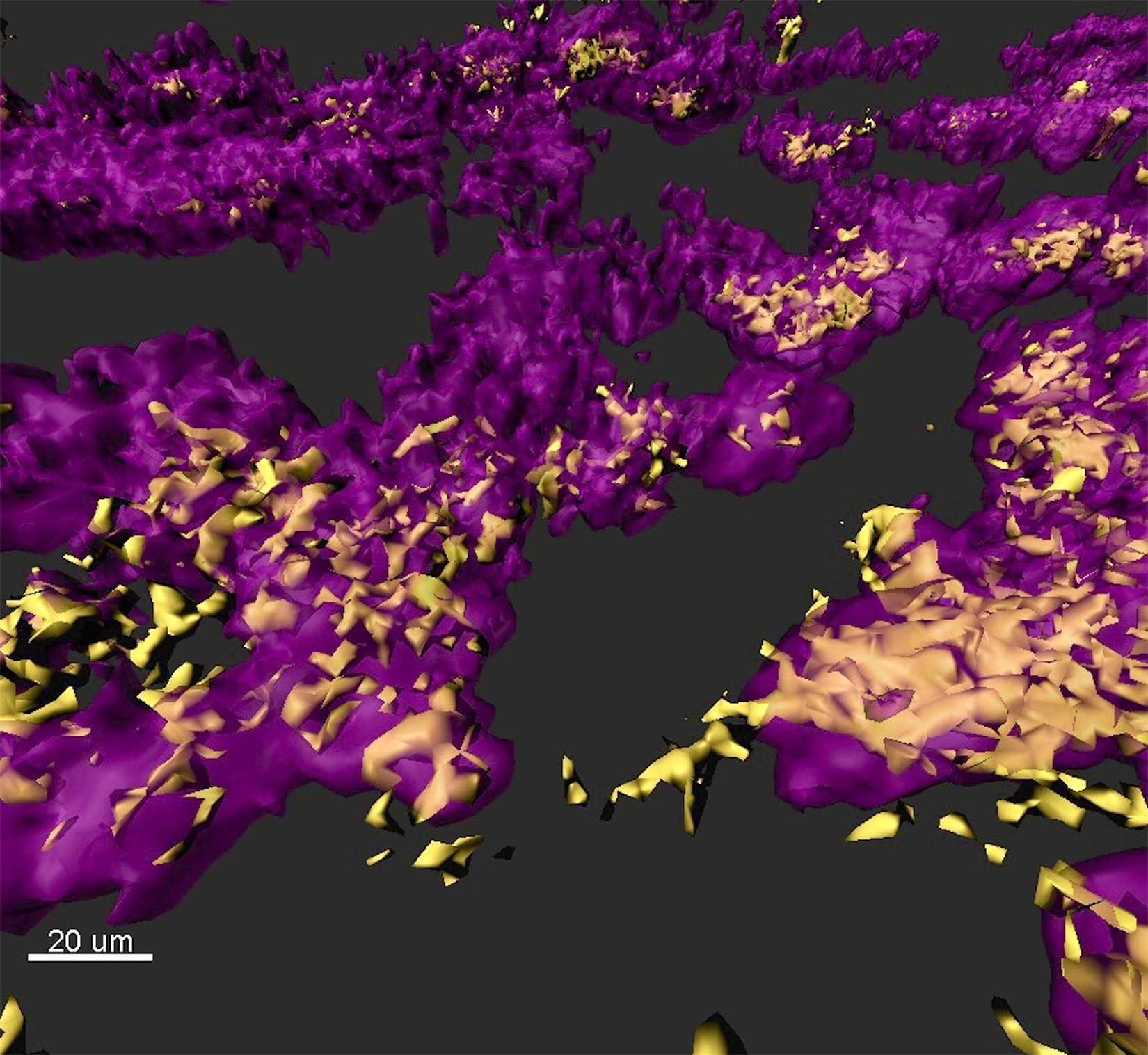 Image shows a rendered confocal laser scanning micrograph of a mixed species bacterial biofilm observed in a chronic wound model of infection. Staphylococcus aureus (yellow) and Pseudomonas aeruginosa (purple), organize themselves in small, dense clusters of cells called aggregates. (Credit: Sophie Darch, Whiteley Lab and Rumbaugh Lab at Texas Tech University Health Sciences Center.) Image shows a rendered confocal laser scanning micrograph of a mixed species bacterial biofilm observed in a chronic wound model of infection. Staphylococcus aureus (yellow) and Pseudomonas aeruginosa (purple), organize themselves in small, dense clusters of cells called aggregates. (Credit: Sophie Darch, Whiteley Lab and Rumbaugh Lab at Texas Tech University Health Sciences Center.)