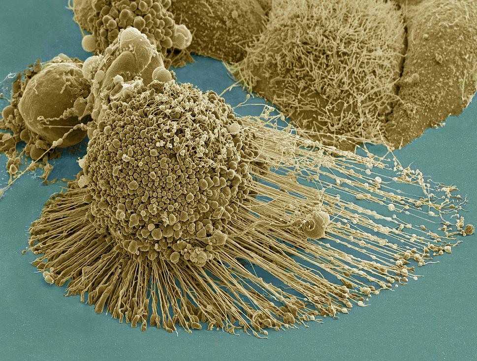A dying cancer cell with filopodia stretched out to its right. The protrusions help cancer migrate. Stock NIH NCMIR image. The image does not display a cell treated in the Georgia Tech study. Credit: NIH-funded image of HeLa cell / National Center for Microscopy and Imaging Research / Thomas Deerinck / Mark Ellisman. Use may require permission.