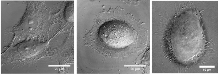 From left to right: Untreated lab culture cancer cell, lab culture cancer cell with gold nanorods attached, lab culture cancer cell after addition of gentle NIR laser light. Credit: Georgia Tech / El-Sayed group