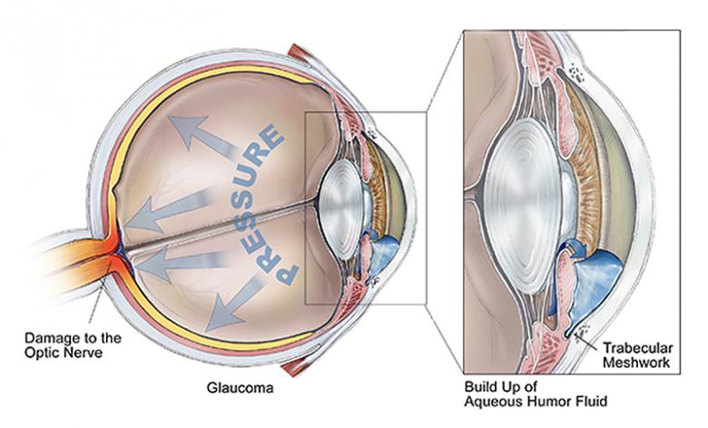 The road to blindness via glaucoma: A depiction of how blockage of fluid flow in the trabecular meshwork, located near the cornea, can lead to pressure build-up in the aqueous humor of the eye, resulting in optic nerve and retinal damage. Credit: BrightFocus Foundation The road to blindness via glaucoma: A depiction of how blockage of fluid flow in the trabecular meshwork, located near the cornea, can lead to pressure build-up in the aqueous humor of the eye, resulting in optic nerve and retinal damage. Credit: BrightFocus Foundation